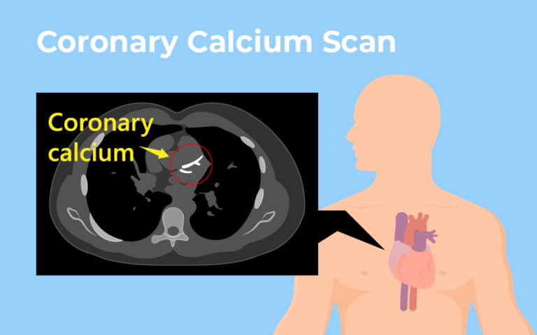 Calcium Score - Bates County Memorial Hospital